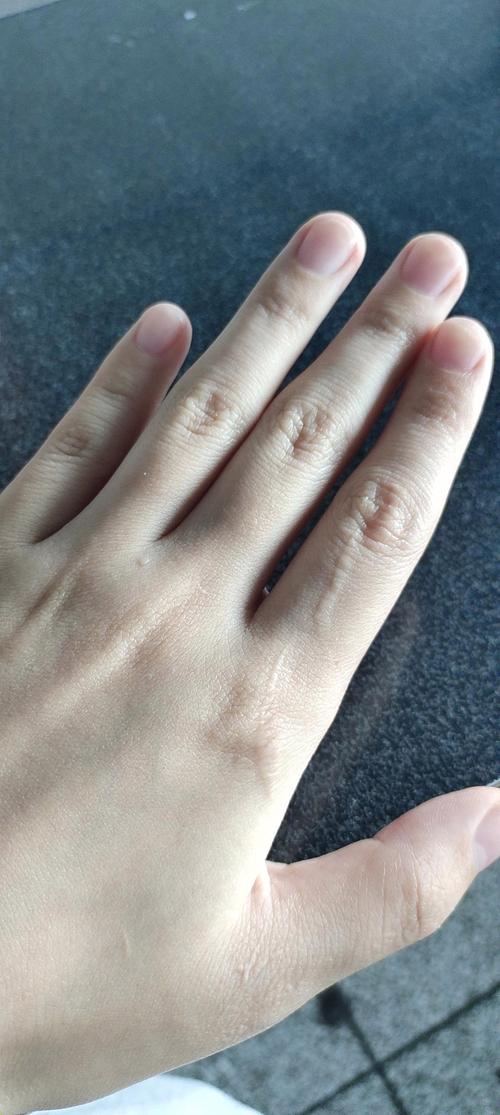 手上有疤痕能参加艺考吗