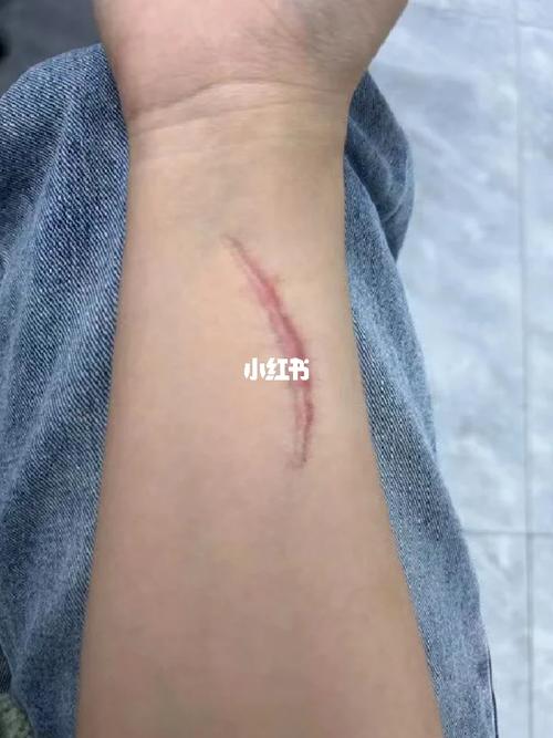 手上有疤痕能参加艺考吗