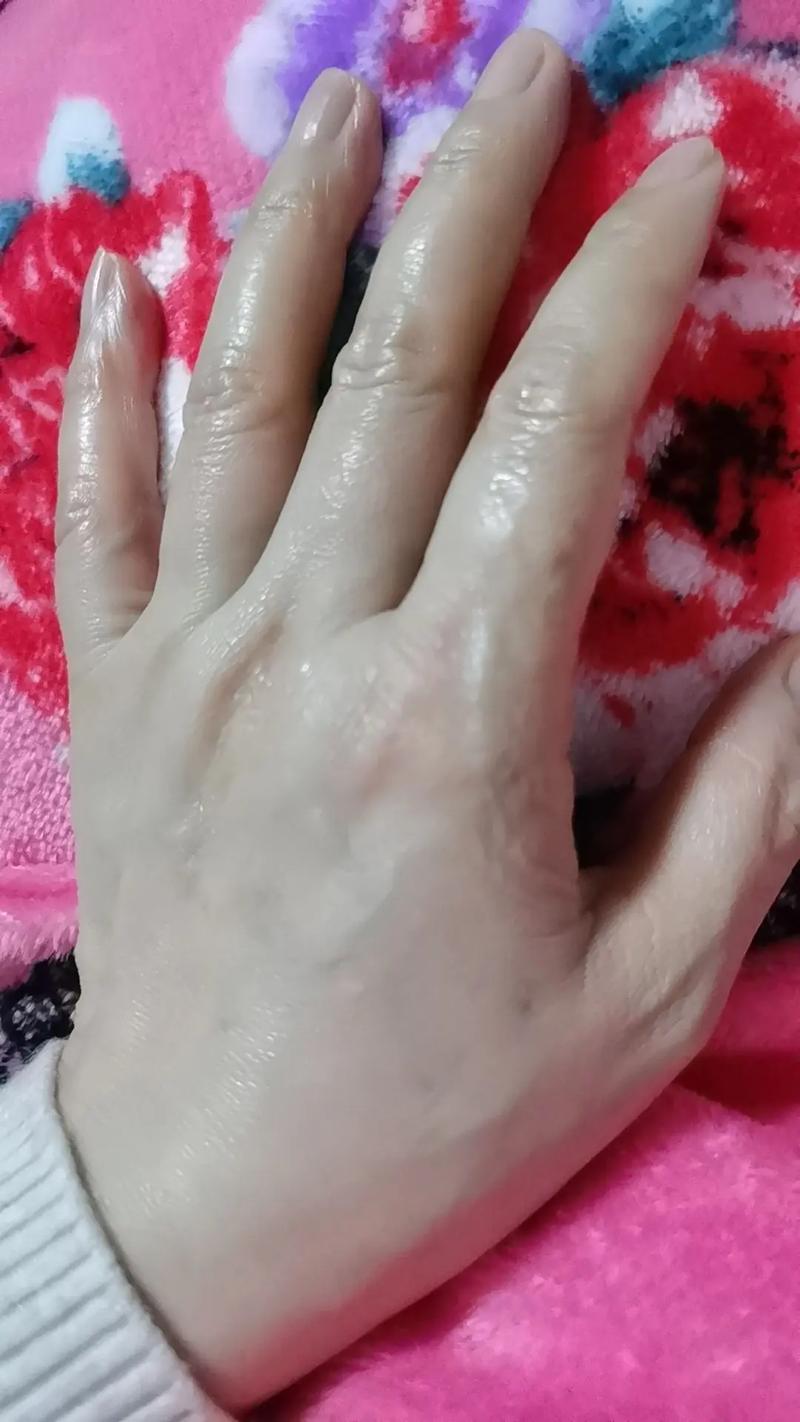 手上有疤痕能参加艺考吗