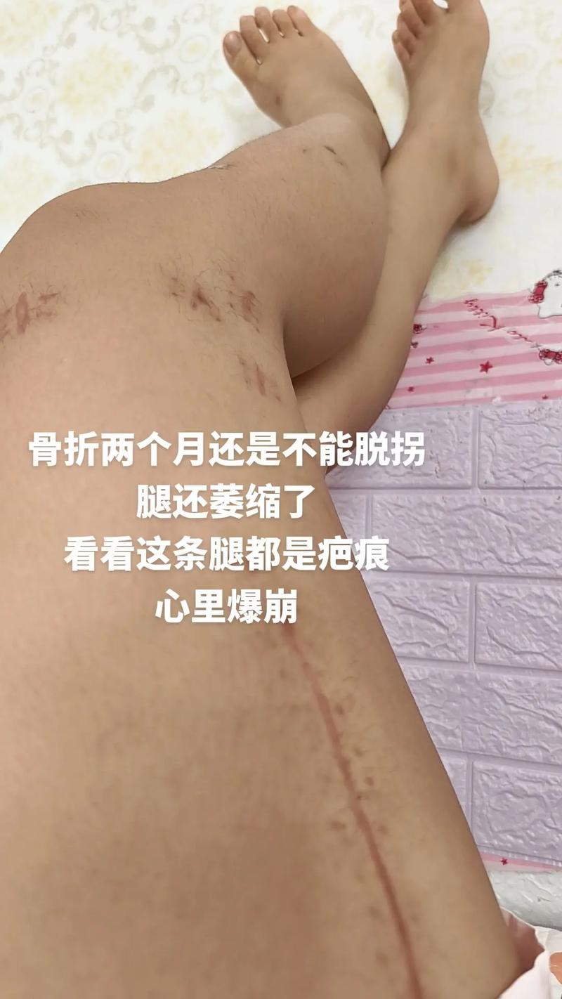 腿上有疤痕能参加艺考吗
