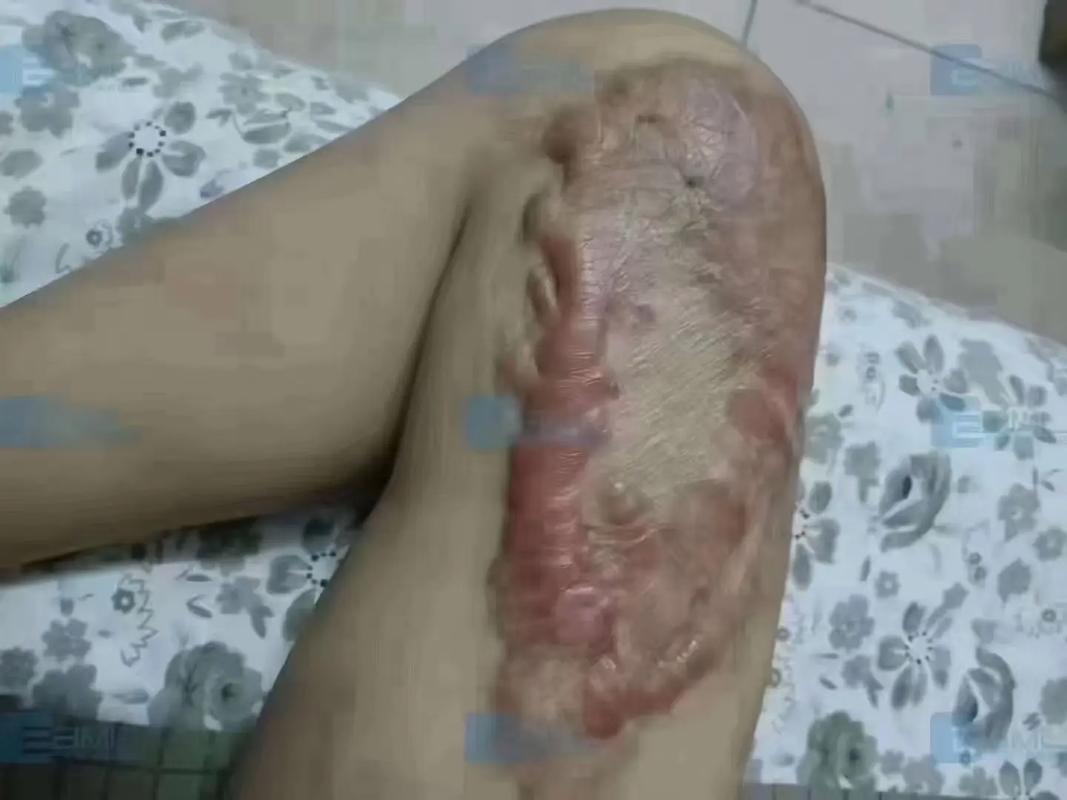 腿上有疤痕能参加艺考吗