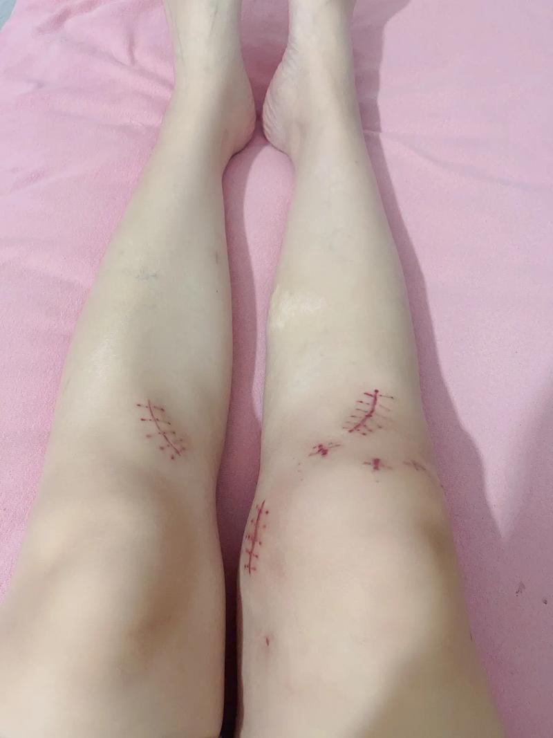 腿上有疤痕能参加艺考吗